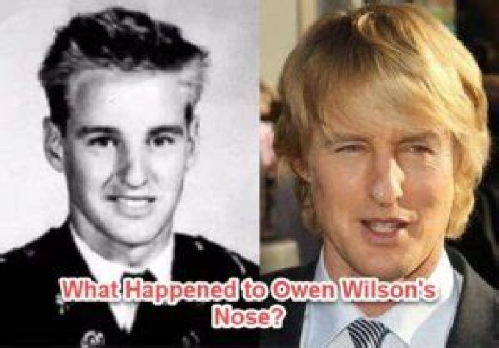 Owen Wilson's Nose And The Truth Behind Its Shape